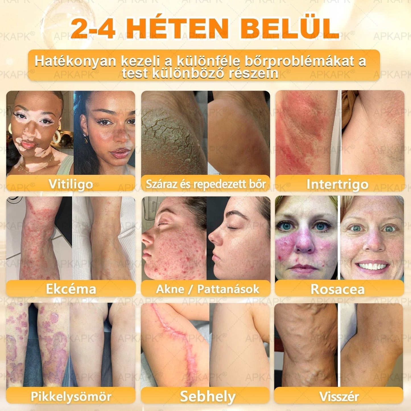 🏆𝖠𝖯𝖪𝖠𝖯𝖪® 🌿Méhméreges bőrregeneráló krém Segít kezelni különféle bőrproblémákat, mint például: ráncok, hegek, pigmentfoltok, striák, pattanások, pikkelysömör, ekcéma, bőrkárosodások, irritációk, gyulladások és egyéb bőrproblémák💦