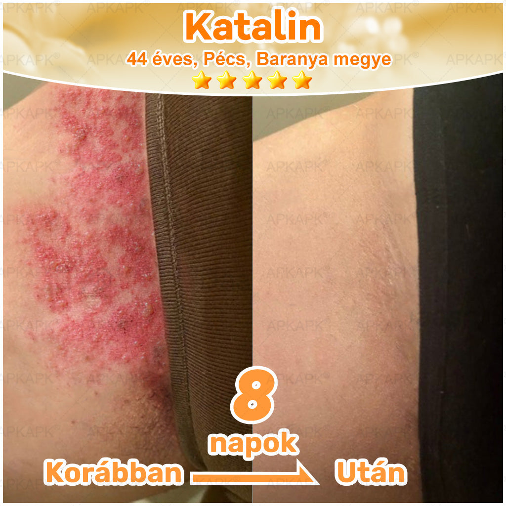 🏆𝖠𝖯𝖪𝖠𝖯𝖪® 🌿Méhméreges bőrregeneráló krém Segít kezelni különféle bőrproblémákat, mint például: ráncok, hegek, pigmentfoltok, striák, pattanások, pikkelysömör, ekcéma, bőrkárosodások, irritációk, gyulladások és egyéb bőrproblémák💦
