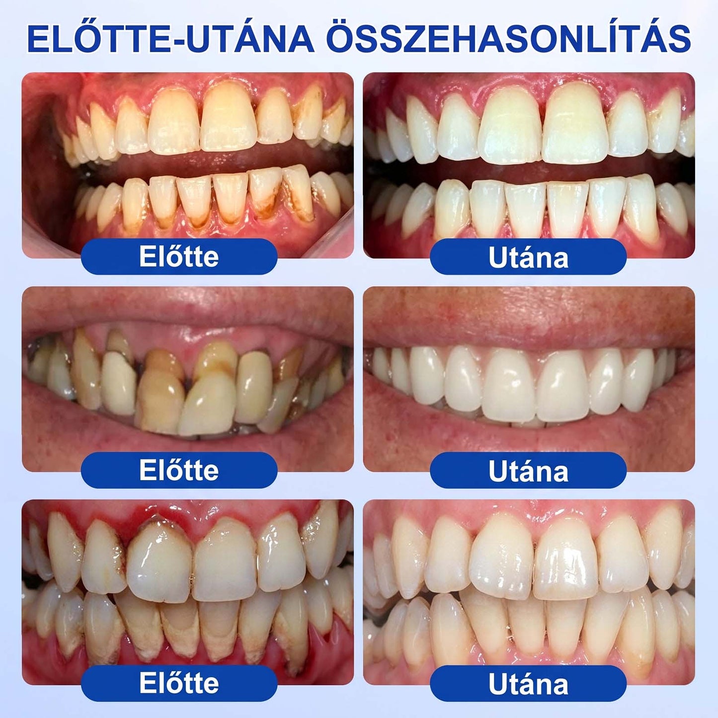 PureShade® 💧 GumRevive Ínyregeneráló Gél – Az egészségesebb ínyért és magabiztosabb mosolyért 🦷