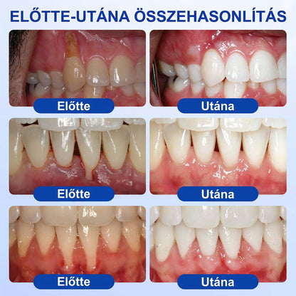 PureShade® 💧 GumRevive Ínyregeneráló Gél – Az egészségesebb ínyért és magabiztosabb mosolyért 🦷