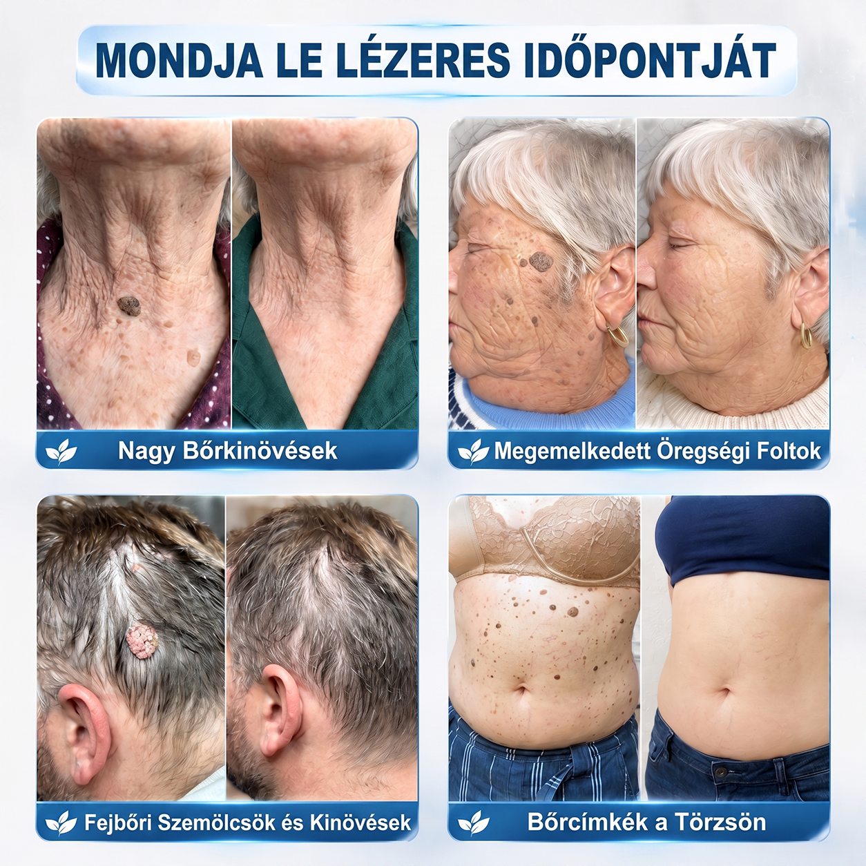 Hivatalos Márkabolt | 🖊️ Hiskin® 7 napos Szemölcseltávolító Roll-on Ápoló Folyadék (Fájdalommentes rollerball technológia, hegek nélkül) 🐬