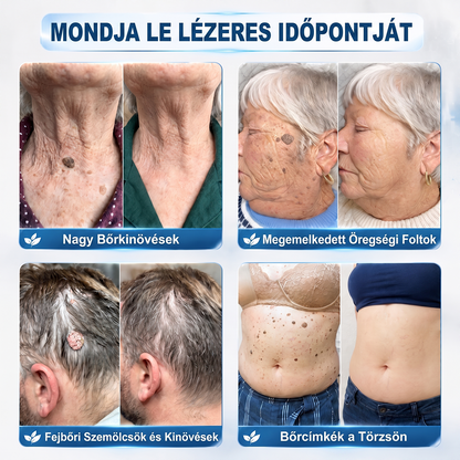Hivatalos Márkabolt | 🖊️ Hiskin® 7 napos Szemölcseltávolító Roll-on Ápoló Folyadék (Fájdalommentes rollerball technológia, hegek nélkül) 🐬
