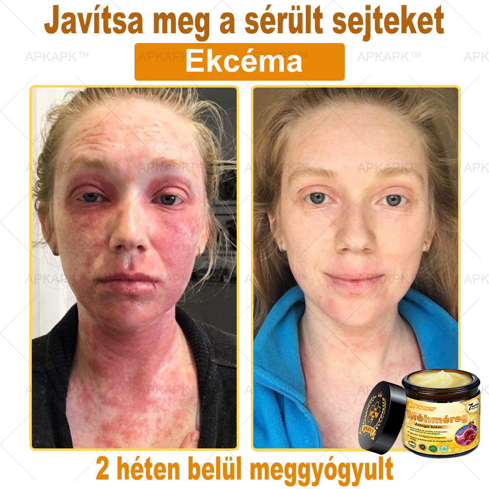 🏆𝖠𝖯𝖪𝖠𝖯𝖪® 🌿Méhméreges bőrregeneráló krém Segít kezelni különféle bőrproblémákat, mint például: ráncok, hegek, pigmentfoltok, striák, pattanások, pikkelysömör, ekcéma, bőrkárosodások, irritációk, gyulladások és egyéb bőrproblémák💦