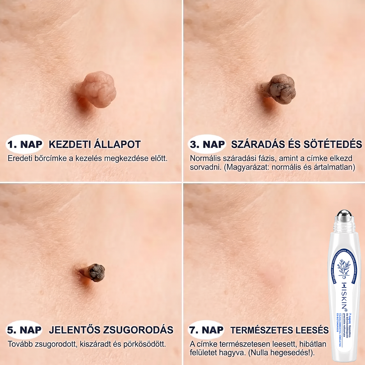 Hivatalos Márkabolt | 🖊️ Hiskin® 7 napos Szemölcseltávolító Roll-on Ápoló Folyadék (Fájdalommentes rollerball technológia, hegek nélkül) 🐬