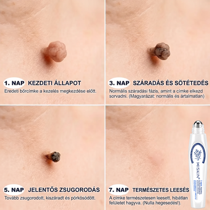 Hivatalos Márkabolt | 🖊️ Hiskin® 7 napos Szemölcseltávolító Roll-on Ápoló Folyadék (Fájdalommentes rollerball technológia, hegek nélkül) 🐬