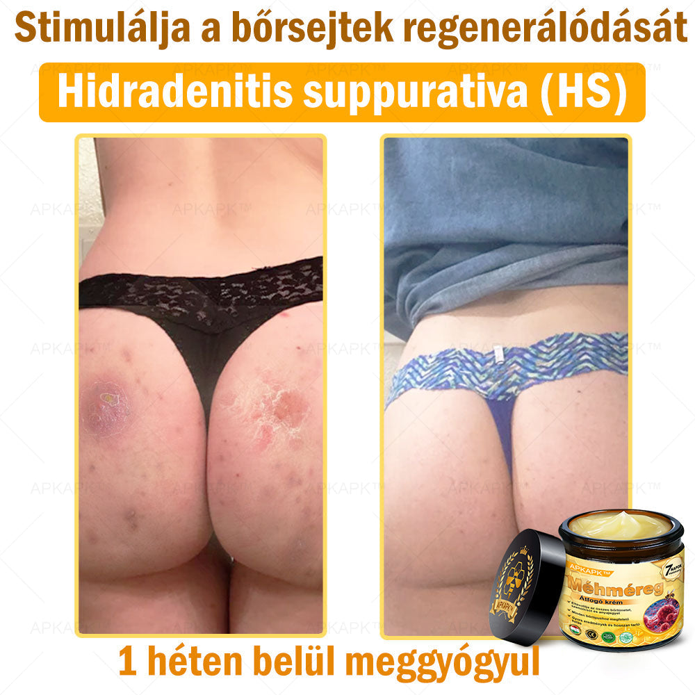 🏆𝖠𝖯𝖪𝖠𝖯𝖪® 🌿Méhméreges bőrregeneráló krém Segít kezelni különféle bőrproblémákat, mint például: ráncok, hegek, pigmentfoltok, striák, pattanások, pikkelysömör, ekcéma, bőrkárosodások, irritációk, gyulladások és egyéb bőrproblémák💦