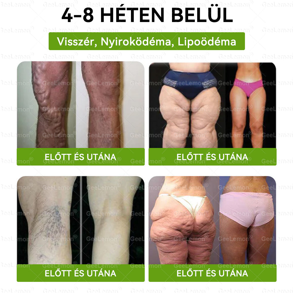 🥇 GeeLemon® 8 az 1-ben karcsúsító nano mikrotűs tapasz 🇭🇺 (Napi egyszeri használat, látható változások már 7 nap alatt) ✅Elhízás,megereszkedett bőr,cukorbetegség,alvási apnoe,ízületi problémák és még sok más esetén